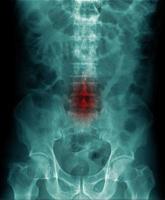 röntgen buk visar lumbal spondylos foto