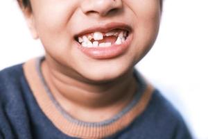 barn med en tand som tappats foto