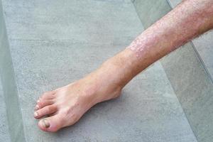 svår psoriasis på en mans ben närbild foto