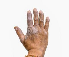 närbild av psoriasis på händerna på bönder isolerad på vit bakgrund, dermatologi hudsjukdom. psoriasis fingrar deformitet. foto
