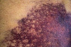 asiatisk kvinna mörkt blåmärke på skinkorna från en halkolycka i badrummet. foto