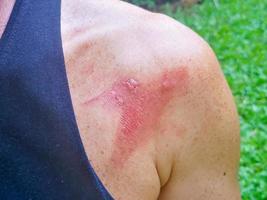hudinflammation med sår orsakad av ett insektsbett, sår från insektsbett har röda brännskador från viruset.mjukt fokus. foto