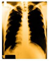 röntgenbild av mänskligt bröst foto