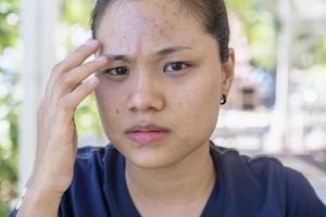ung asiatisk kvinna oroar sig för hennes ansikte när hon har problem med huden i ansiktet i en naturlig bakgrund. problem med akne och ärr på den kvinnliga huden. problem hudvård och hälsokoncept. foto