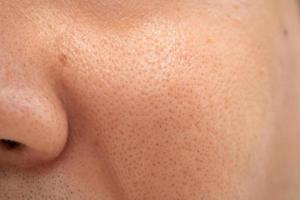 asiatisk manlig näsa och kind närbild har hudproblem, stora porer, whitehead och pormask finne. porer i ansiktet på en man. foto