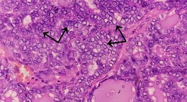 sköldkörtelcancer, mikroskopisk bild av metastaserande papillärkarcinom i sköldkörteln, central lymfkörtel. foto