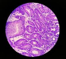 mikrofotografi eller mikroskopisk bild av magcancer. adenokarcinom i magen foto