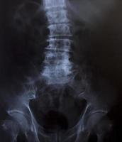 röntgenbild av mänskligt bröst för en medicinsk diagnos
