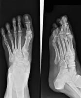 röntgen av foten foto