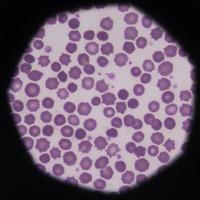 onormala röda blodkroppar echinocyt.