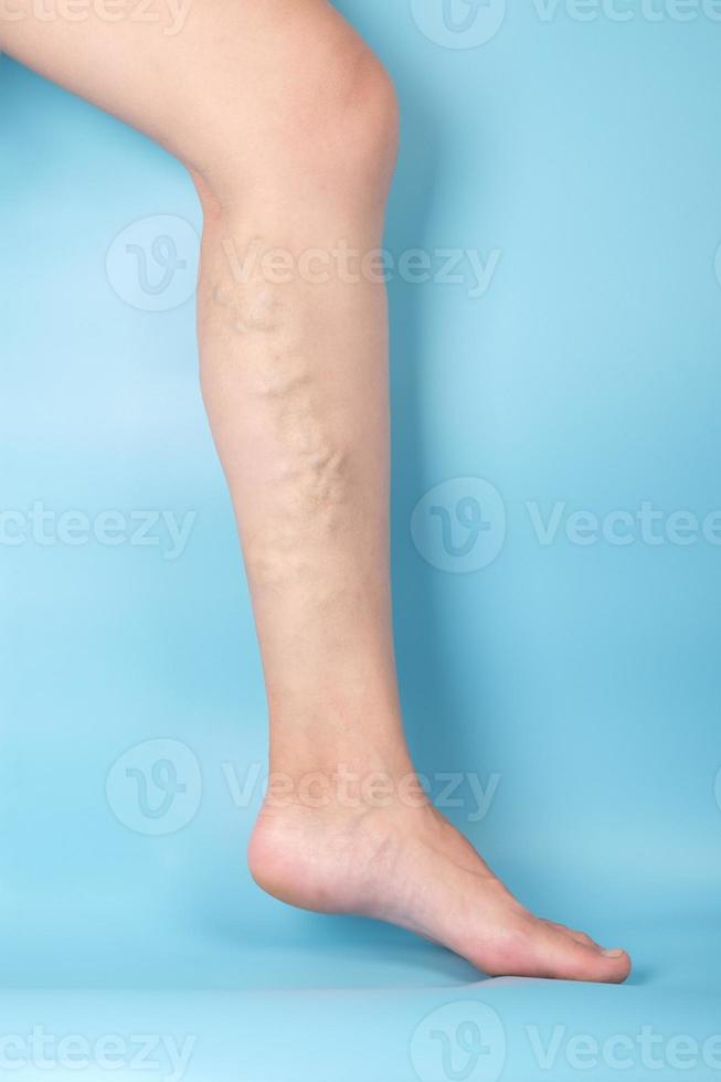 vrouwenbeen met verstopping van spataderen op een blauwe achtergrond foto
