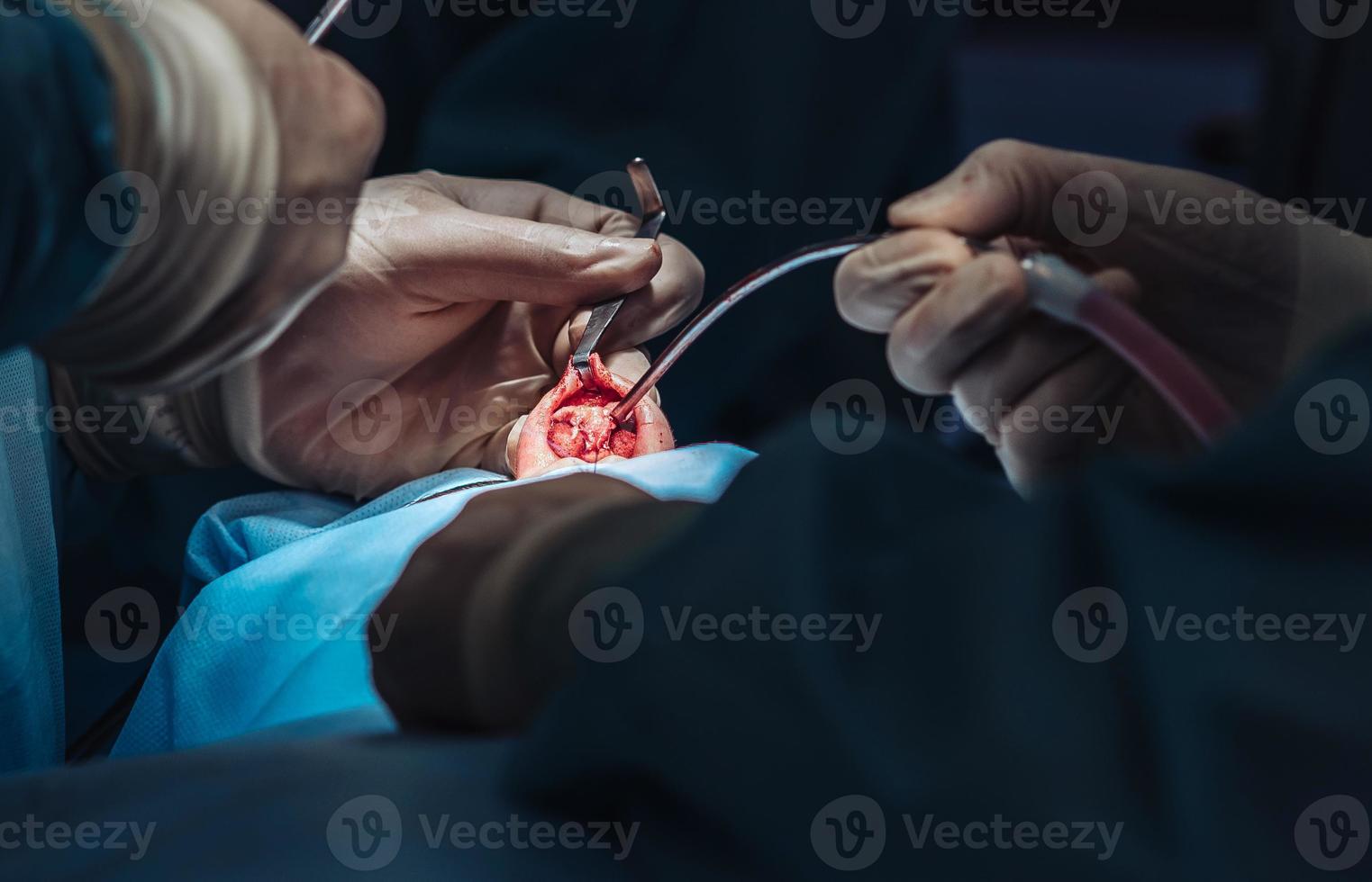 kunstmatig chirurgie Aan neus. de chirurg bezuinigingen de vlees foto