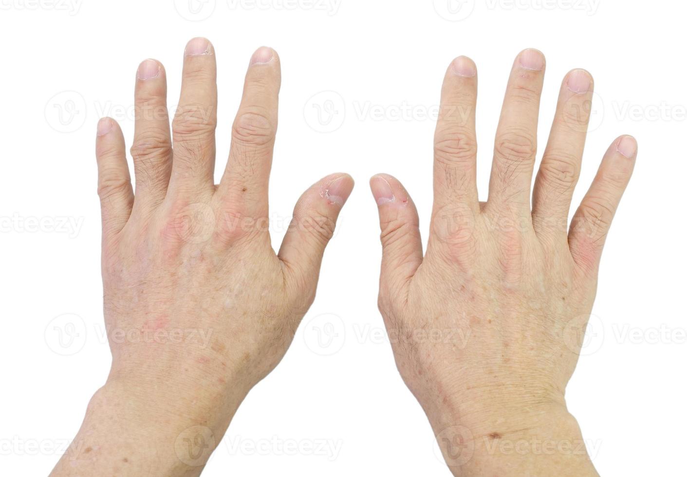 klein bruin vlekken Aan de huid van de senior man's handen. vingers en nagels met droog huid, gescheurd en schilfering uit, gebarsten huid Aan nagelriemen, geïsoleerd Aan wit achtergrond. foto