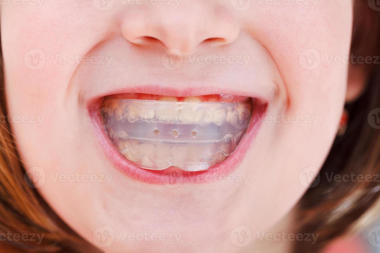correctie van occlusie door orthodontisch trainer foto