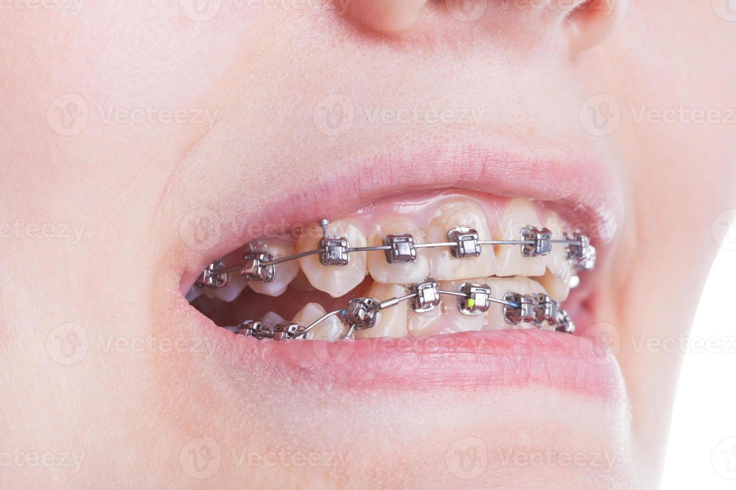 orthodontisch een beugel Aan tanden dichtbij omhoog foto