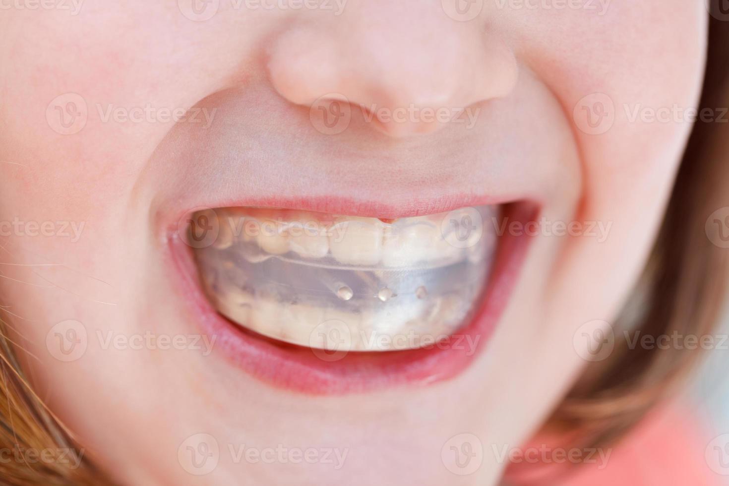 correctie van occlusie door orthodontisch trainer foto