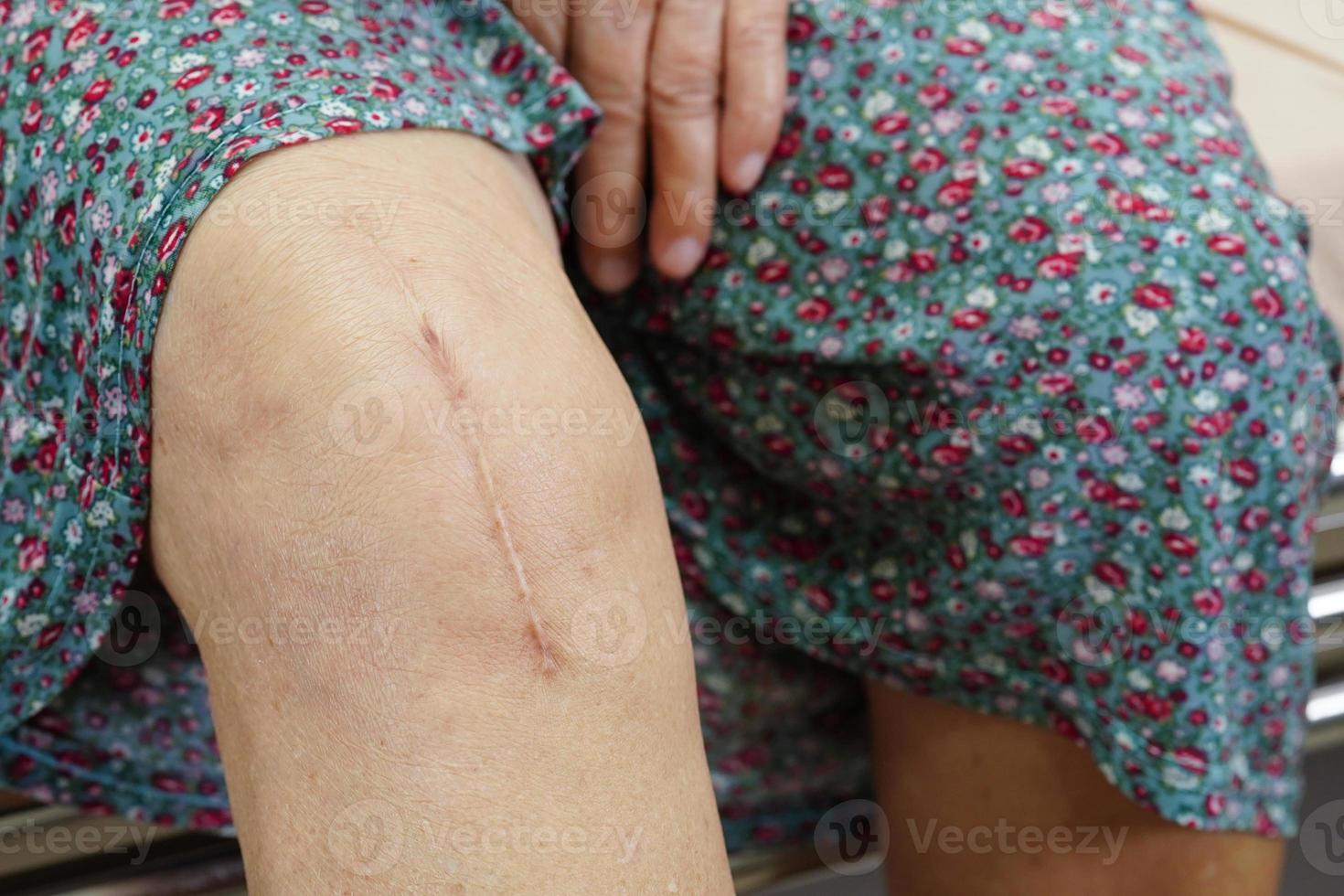Aziatische oudere vrouw patiënt met litteken knie vervangende operatie in het ziekenhuis. foto