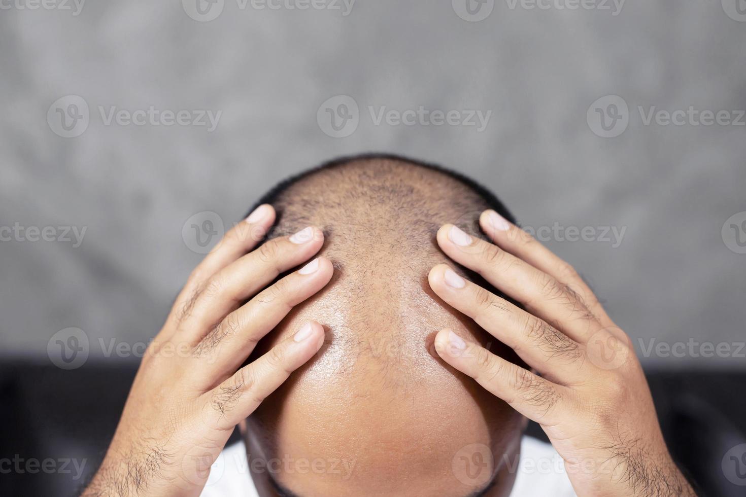 kaal Mens met haar- problemen foto