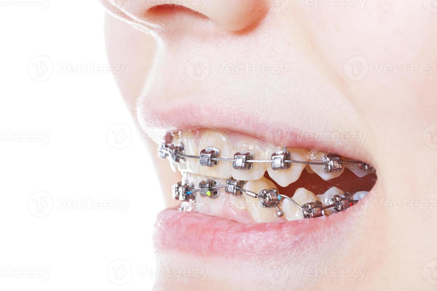 tandheelkundig staal een beugel Aan tanden dichtbij omhoog foto