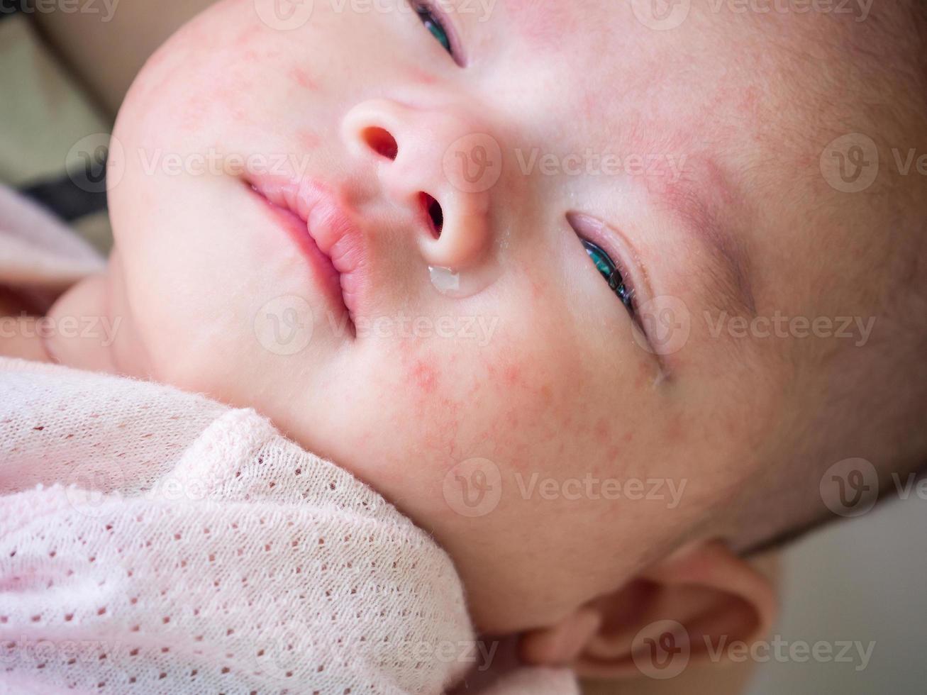 pasgeboren baby met allergie Aan gezicht foto