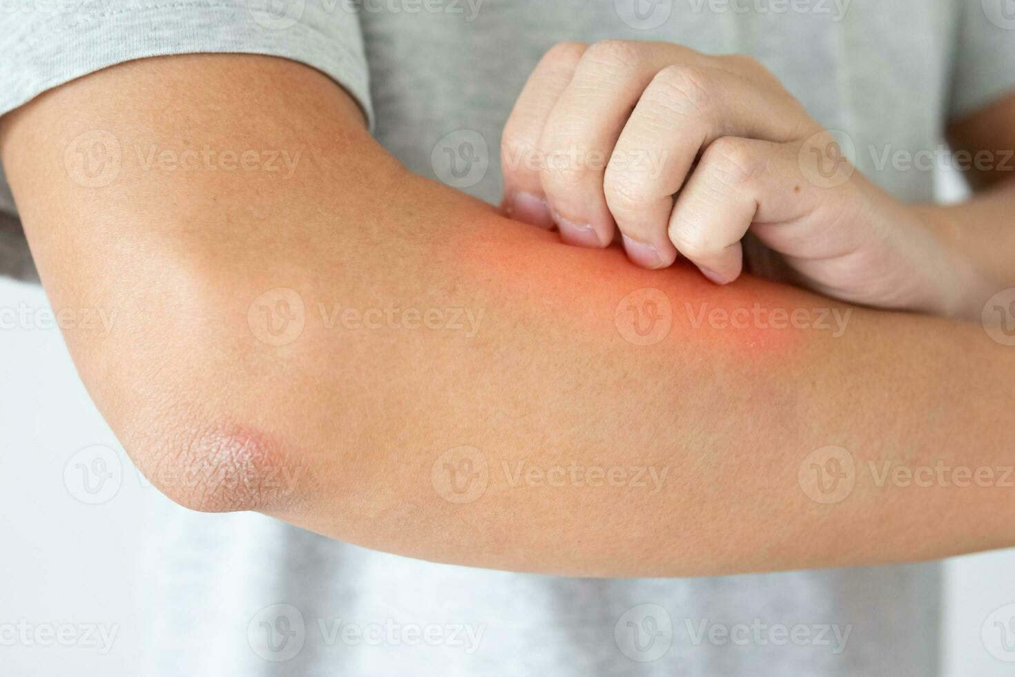 jong Aziatisch Mens jeuk en krabben Aan arm van jeukend droog huid eczeem dermatitis foto