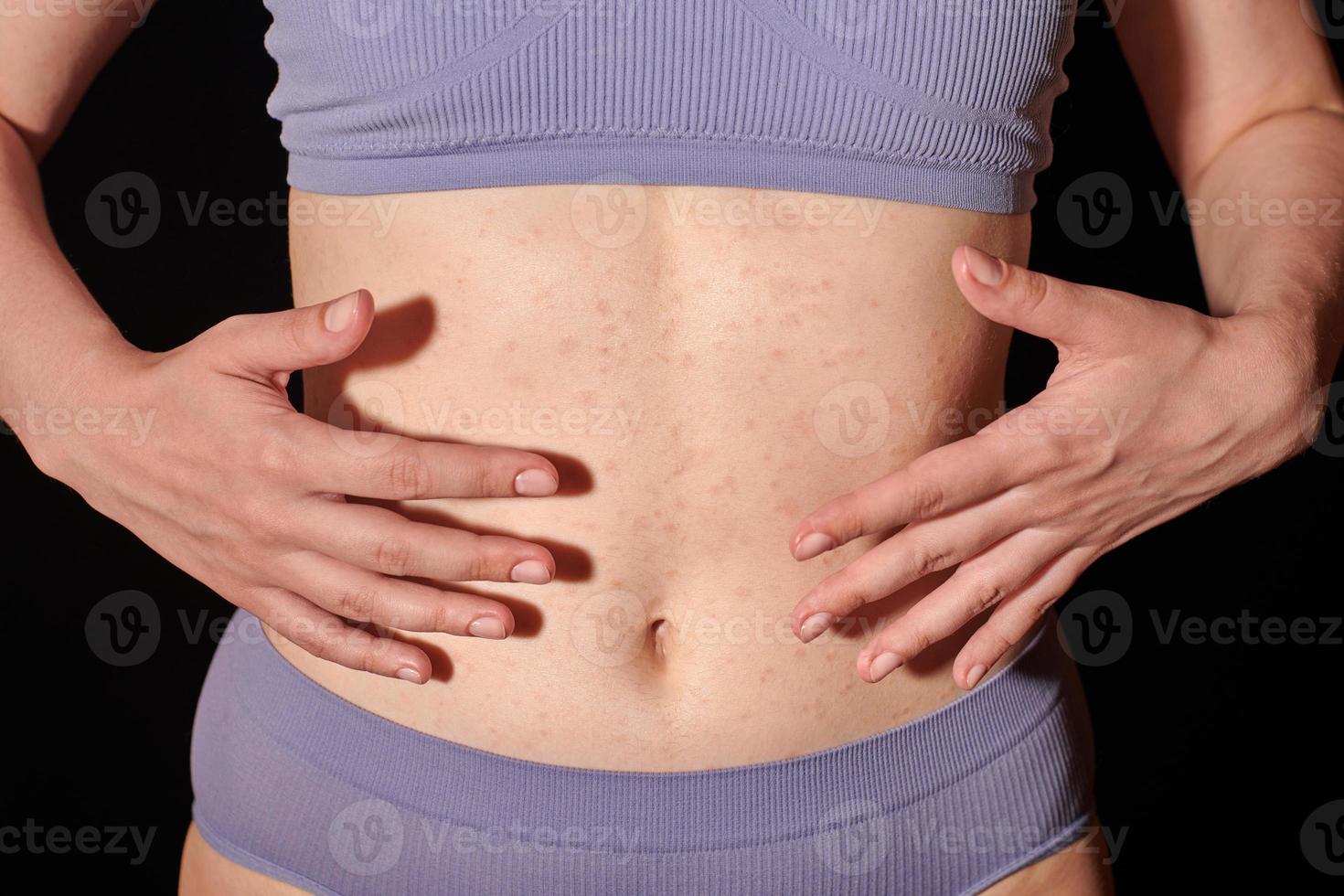 rode allergische uitslag op de buikhuid, huidallergie, atopische dermatitis, eczeem. vrouw die zalf aanbrengt foto