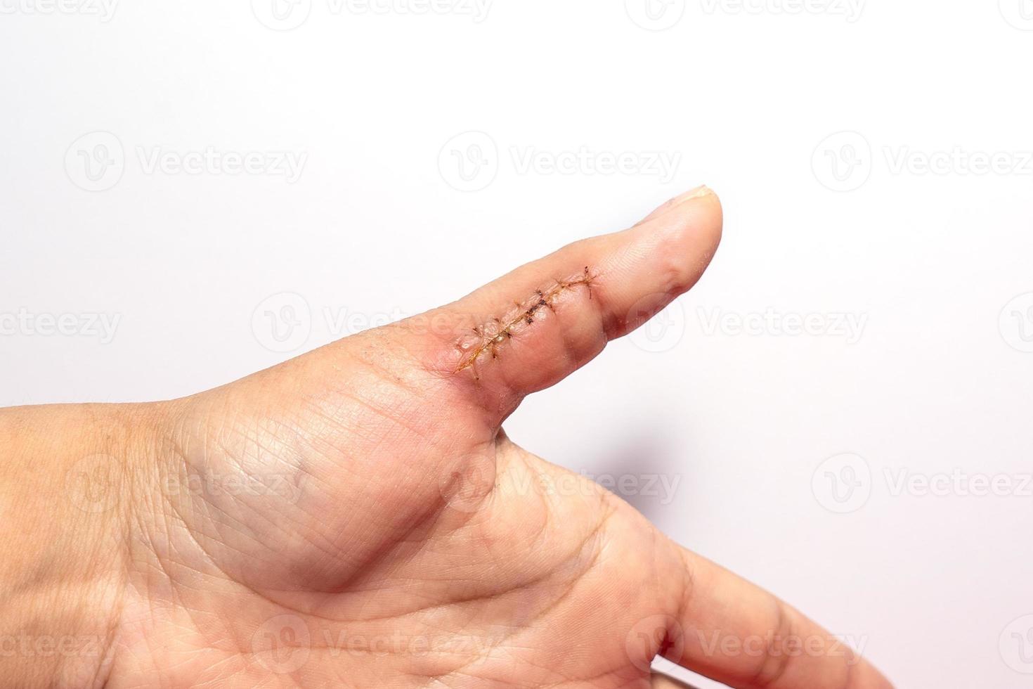 detailopname van een hand- wond met hechtingen, duim wond Aan wit achtergrond. litteken, hechten, ongeluk foto