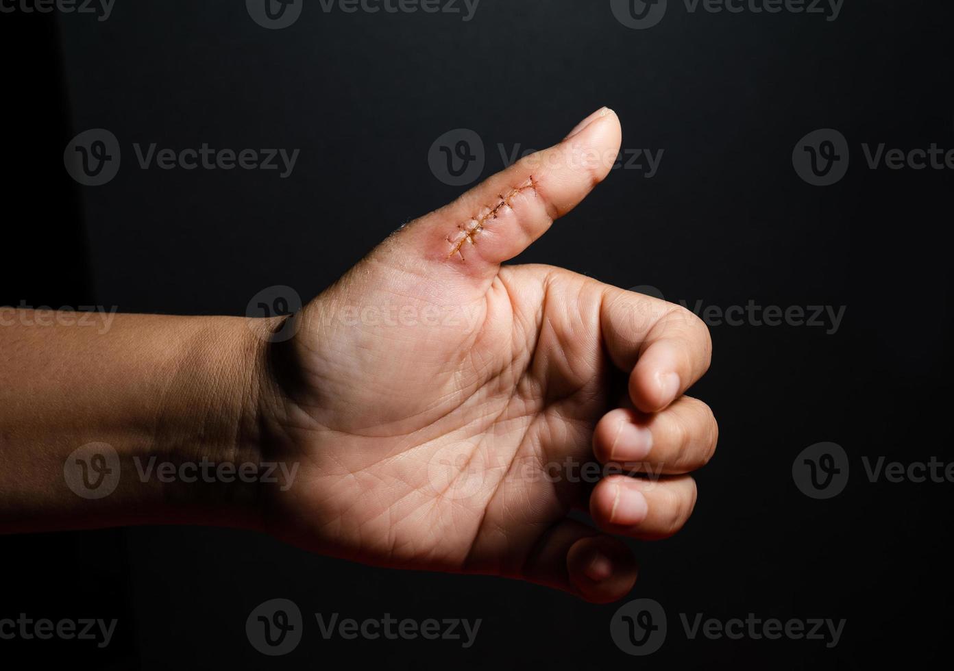 detailopname van een hand- wond met hechtingen, duim wond Aan zwart achtergrond. litteken, hechten, ongeluk foto