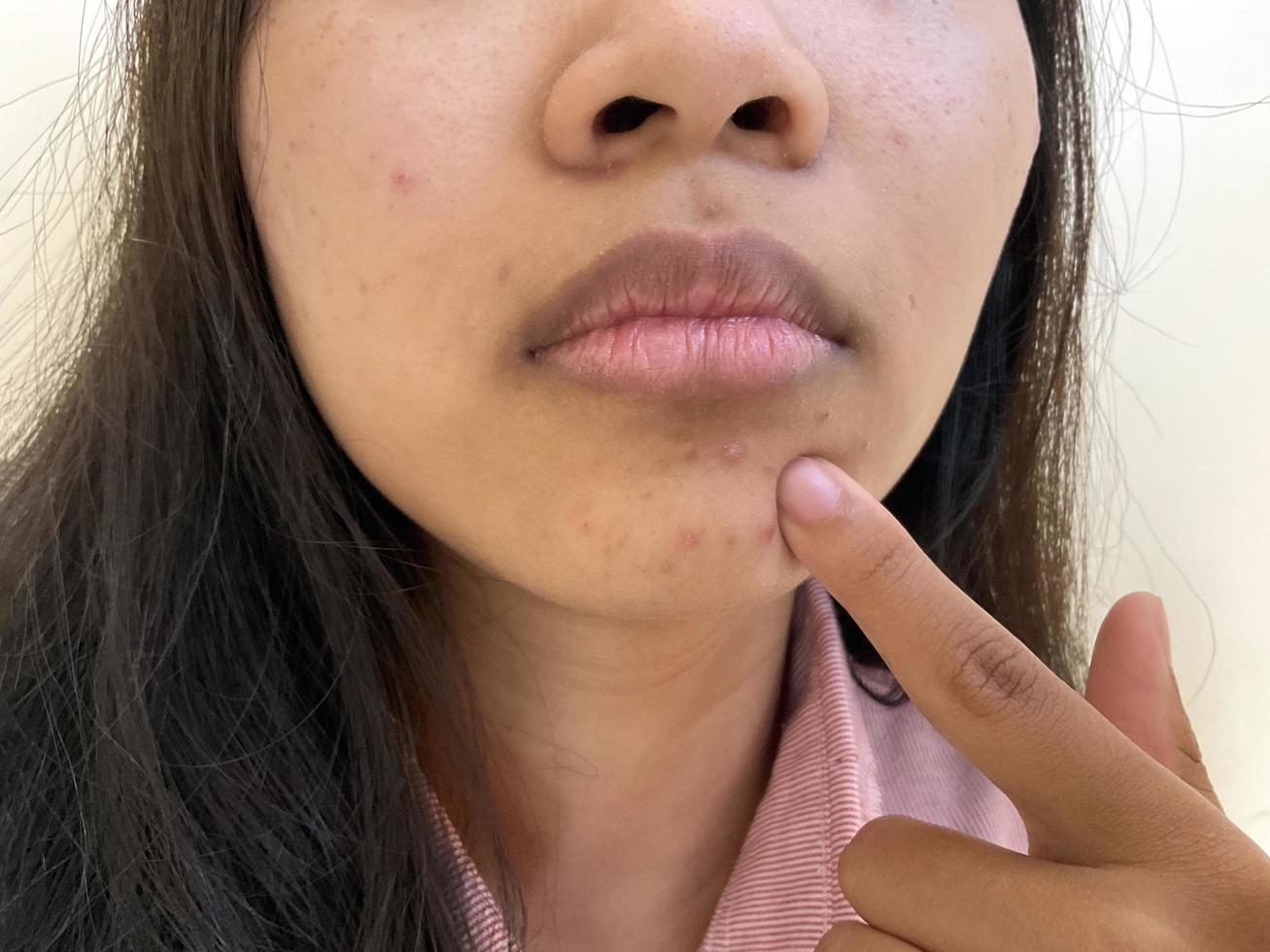 acne Aan de gezicht van Aziatisch vrouw. schoonheid en huid probleem concept foto