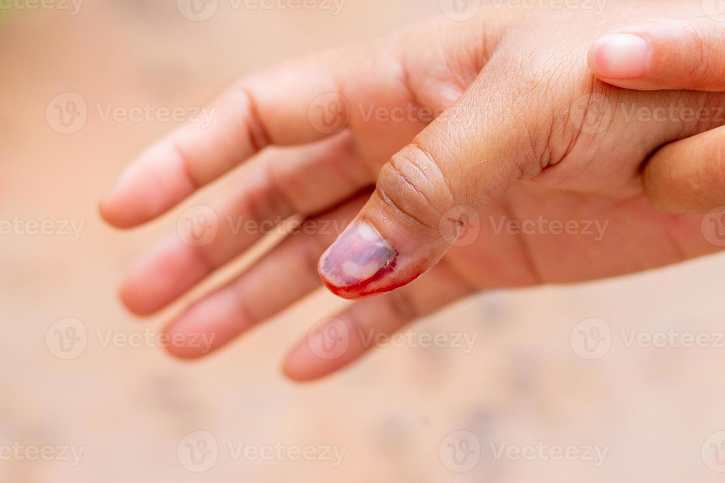 menselijk vinger met zwart gekneusd nagel met bloed foto
