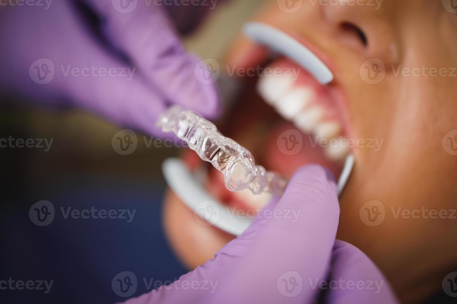 invisalign een beugel visie foto