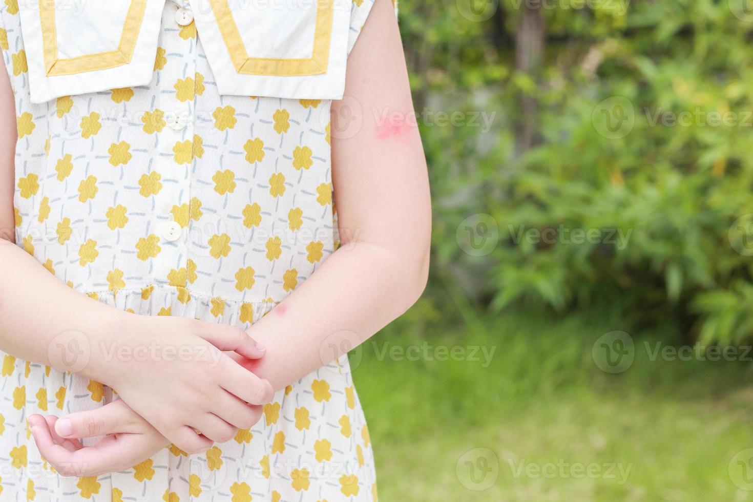 weinig meisje heeft huid uitslag allergie jeuk en krabben Aan haar arm foto