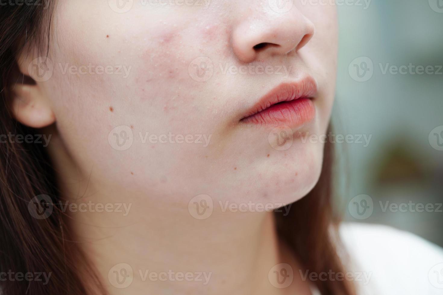 acne puistje en litteken op de huid gezicht, aandoeningen van de talgklieren, tienermeisje huidverzorging schoonheidsprobleem. foto