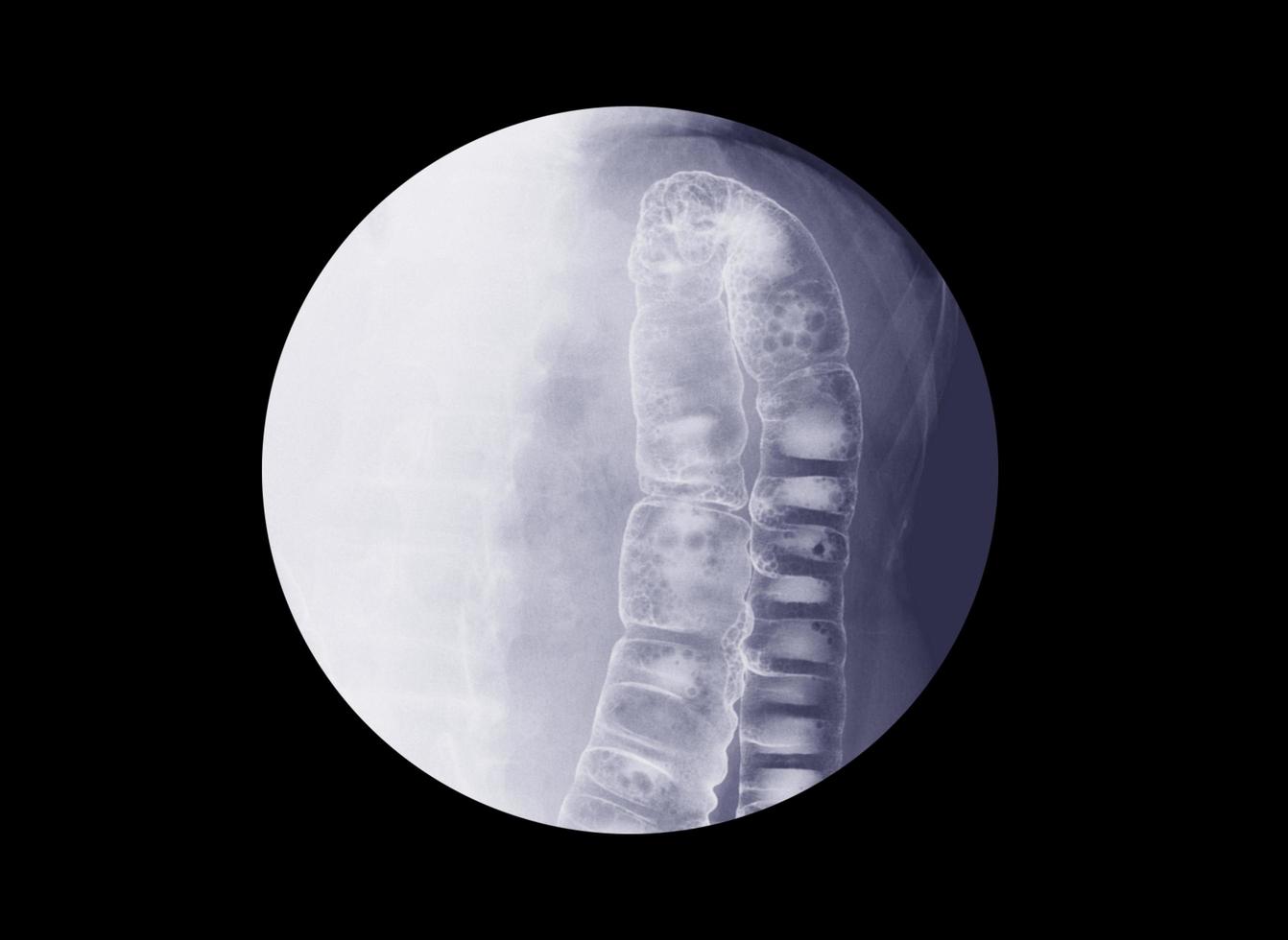 barium klysma examen foto