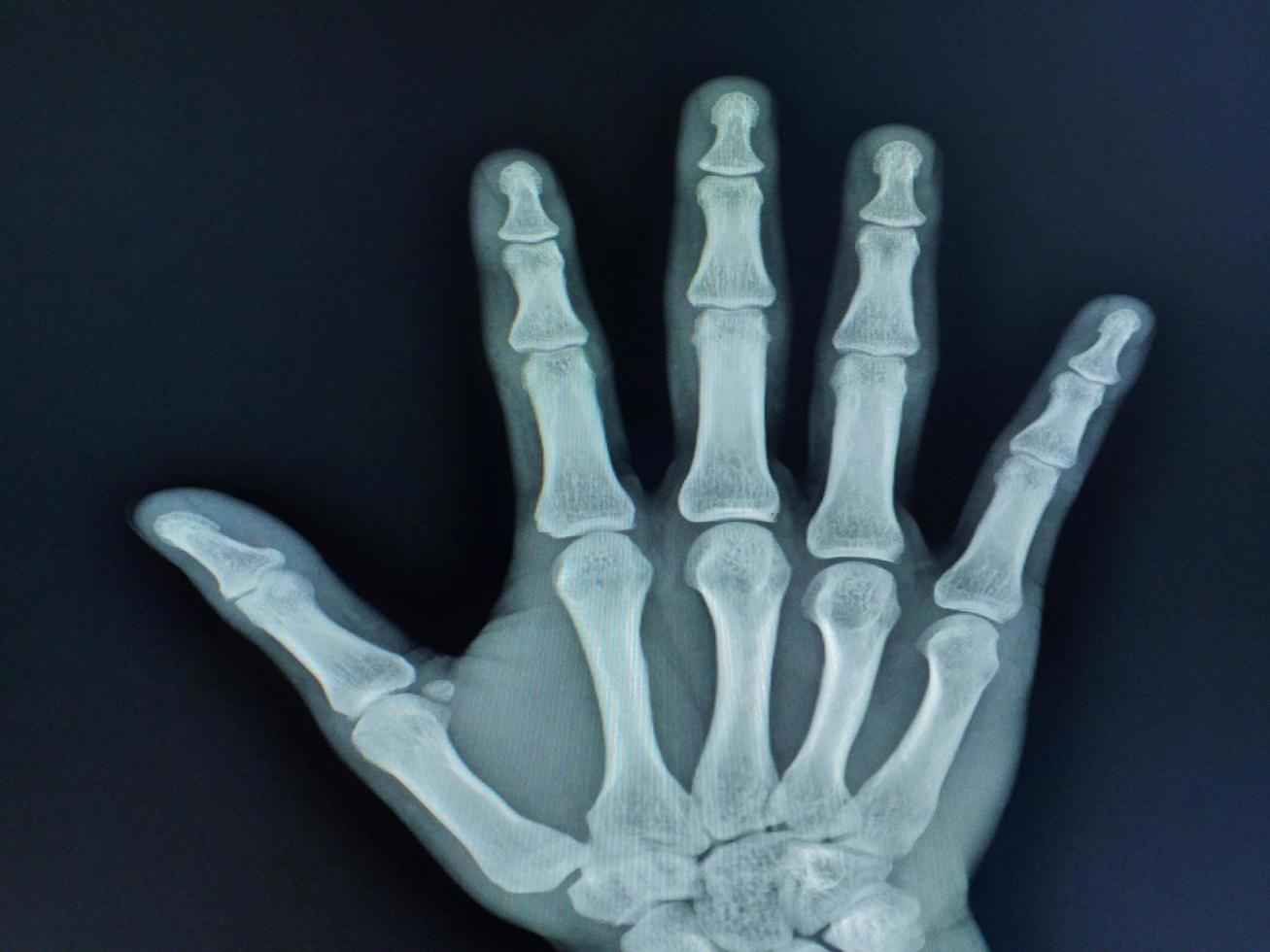 film röntgenstraal hand- ap visie tonen van mensen hand- normaal foto