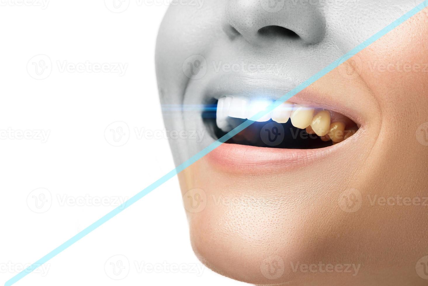 resultaat na tanden bleken behandeling in de professioneel tandheelkundig kliniek. foto