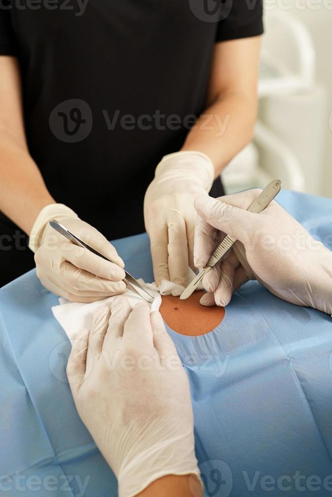 dokter en verpleegster gedurende moedervlek verwijdering dermatologisch chirurgie foto