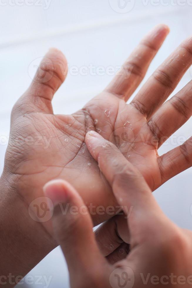 dichtbij omhoog van droog gebarsten huid van een Mannen hand- foto