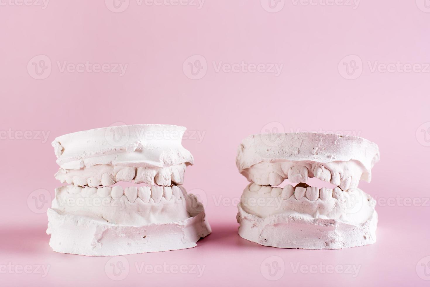 twee gips afgietsels van scheef kinderen tanden Aan een roze achtergrond. tandheelkunde en orthodontie foto