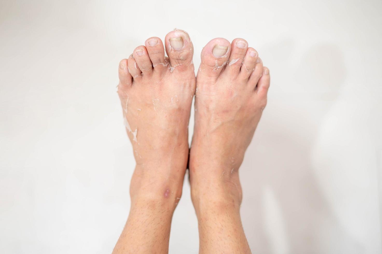 dichtbij omhoog van pellen uit en gebarsten voet ten gevolge naar een allergisch chemisch reactie. foto