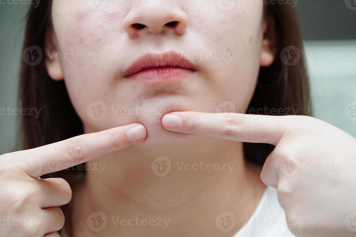 acne puistje en litteken op de huid gezicht, aandoeningen van de talgklieren, tienermeisje huidverzorging schoonheidsprobleem. foto