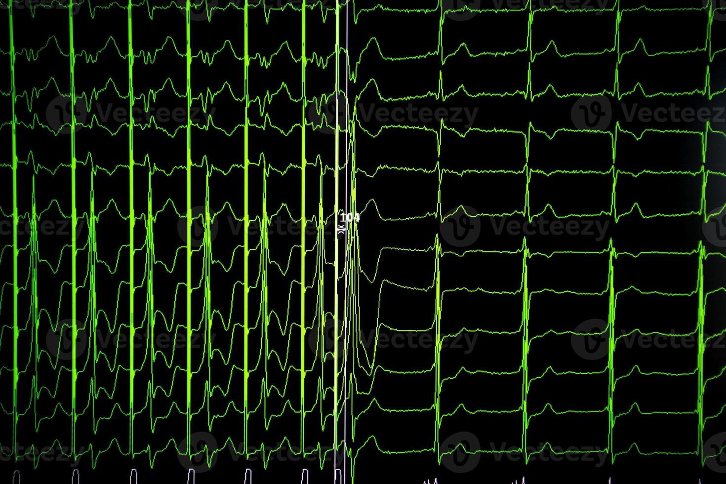 medisch achtergrond kardiogram Aan de monitor. foto
