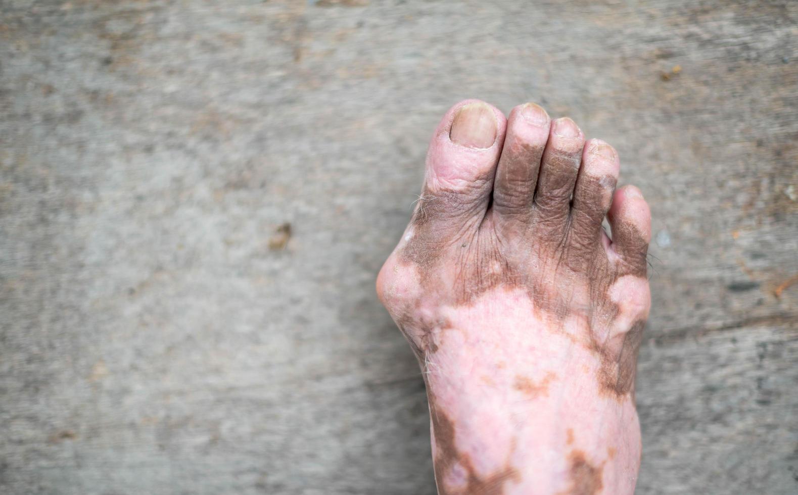 de oud Mens been met huid staat dat oorzaken verlies van melanine poseren binnenshuis. de voet model- in zwart tank top lijden van vitiligo wanorde. foto