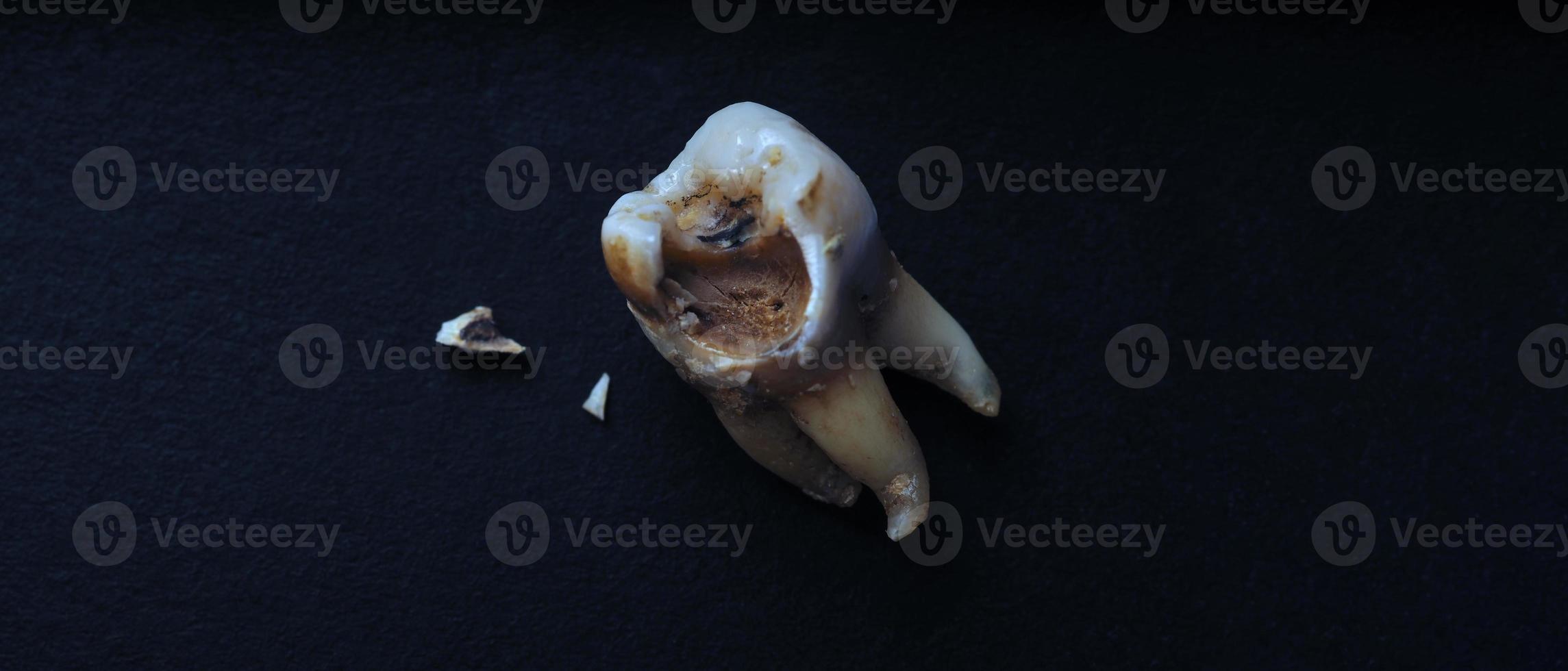 macro schot van een vervallen tanden tot wortel na extractie van tandarts. foto