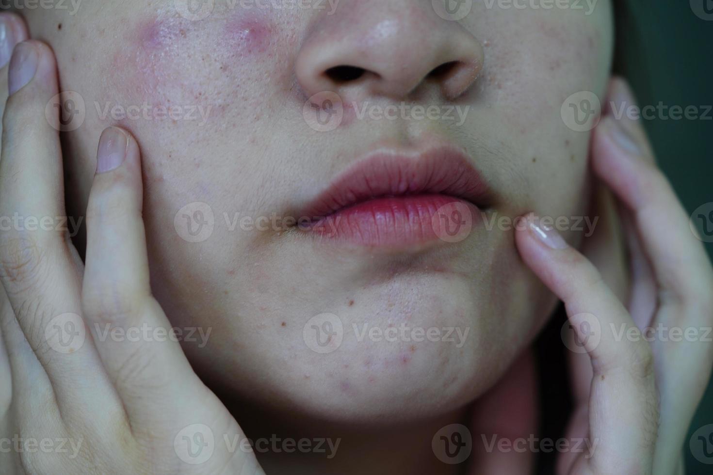 acne puistje en litteken op de huid gezicht, aandoeningen van de talgklieren, tienermeisje huidverzorging schoonheidsprobleem. foto