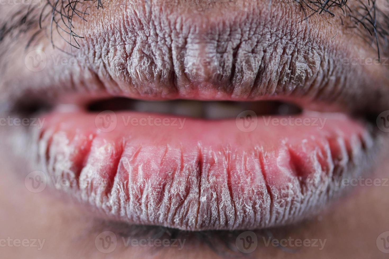 dichtbij omhoog van droog lip van een jong mannen foto