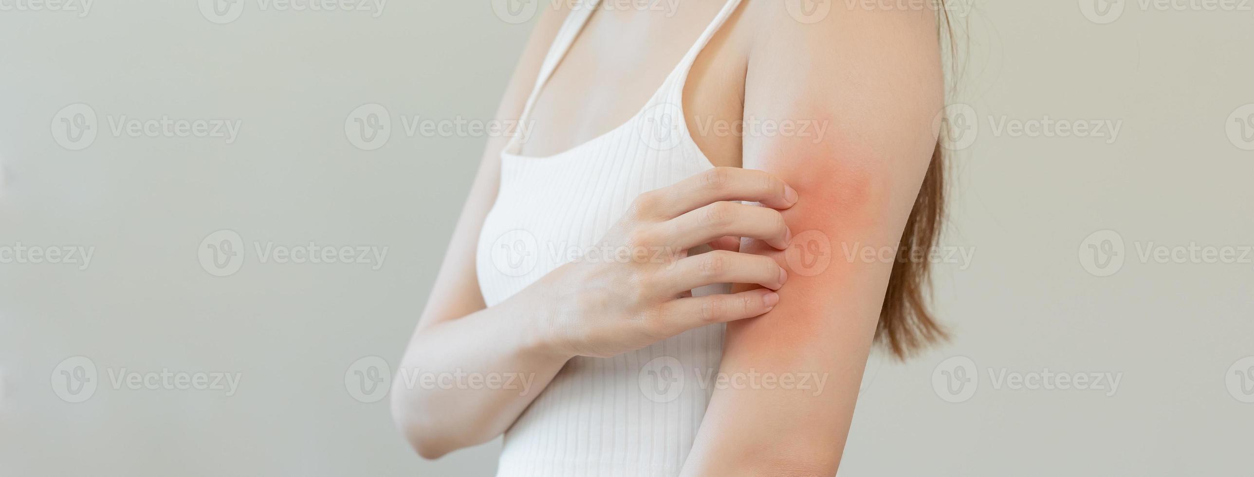 dermatologie, Aziatisch jong vrouw, meisje allergie, allergisch reactie van atopisch, insect bijt Aan haar arm, hand- in krabben jeukend, jeuk rood plek of uitslag van huid. gezondheidszorg, behandeling van schoonheid. foto