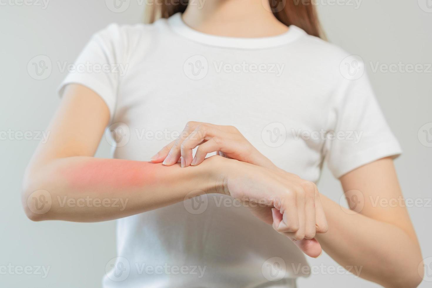 dermatologie Aziatisch jong vrouw, meisje allergie, allergisch reactie van atopisch, insect bijt Aan haar arm, hand- in krabben jeukend, jeuk rood plek of uitslag van huid. gezondheidszorg, behandeling van schoonheid. foto