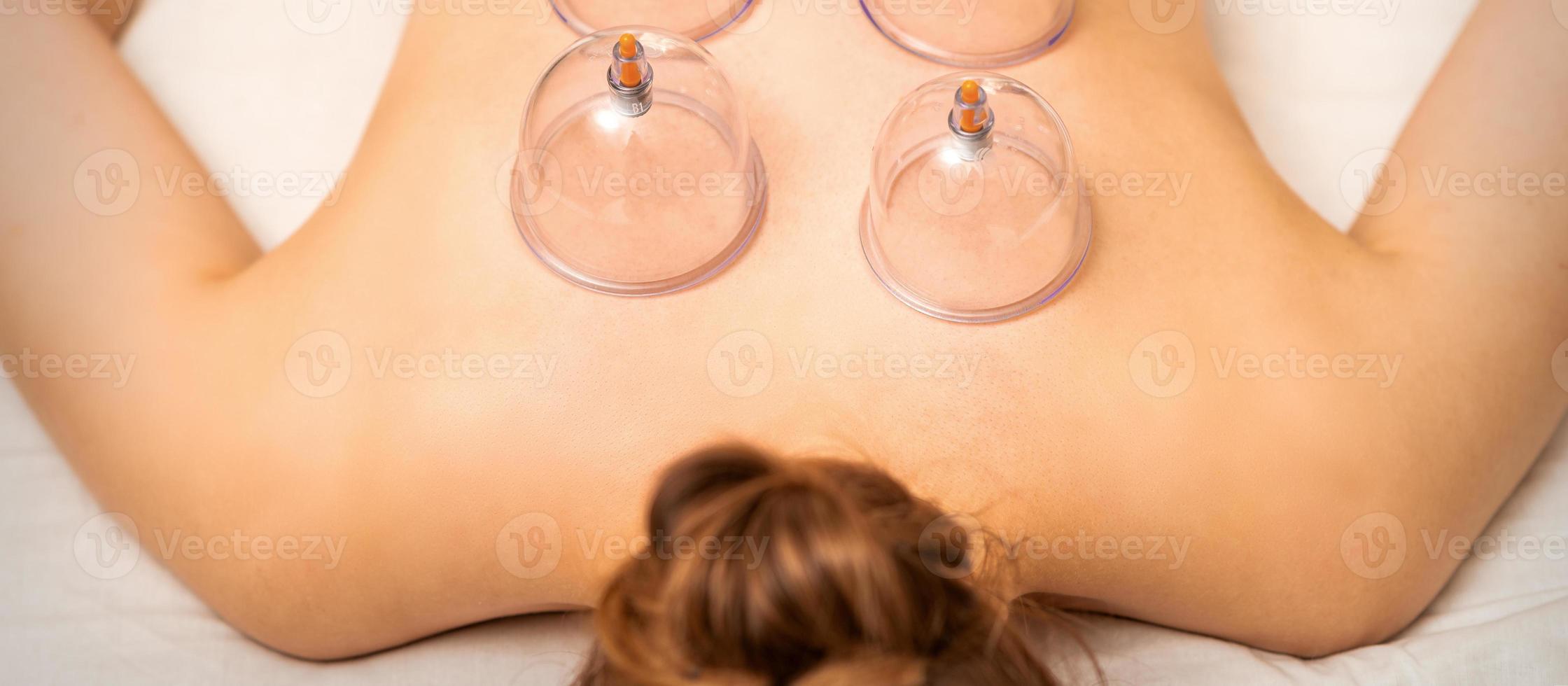 medisch cupping behandeling Aan terug foto