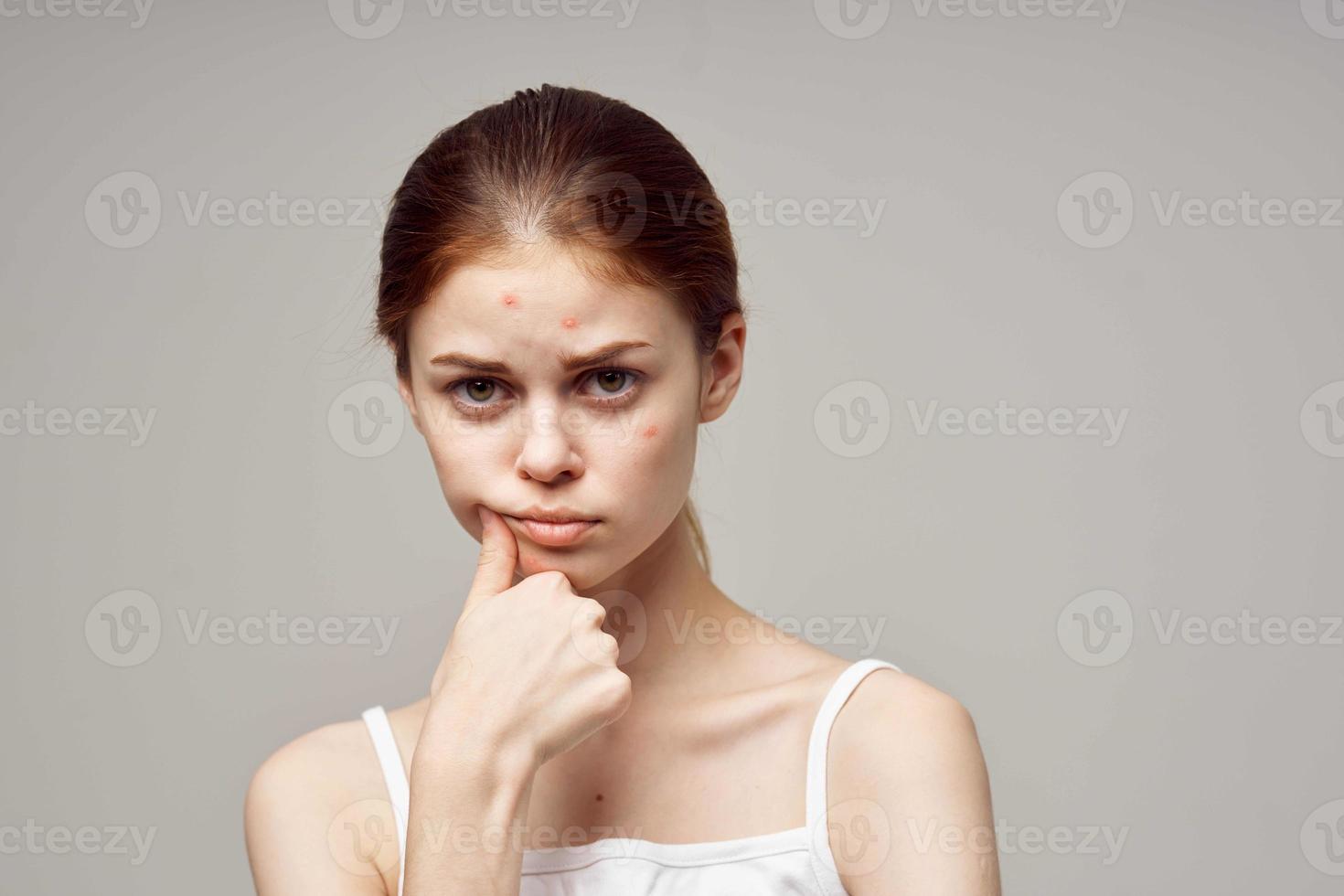 roodharig vrouw met puistjes Aan de gezicht hygiëne geïsoleerd achtergrond foto